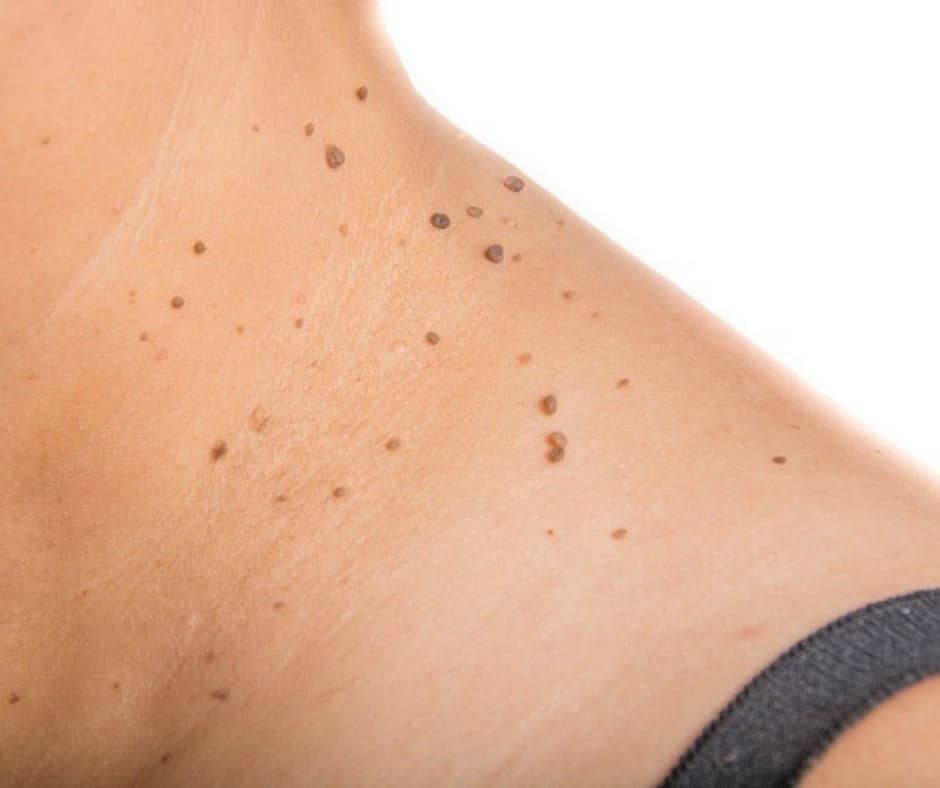 Lesões benignas - Dra. Juliana Araújo, dermatologista em Barbacena