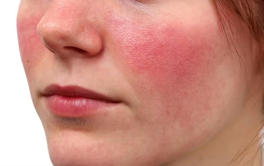 Rosácea - Dra. Juliana Araújo, dermatologista em Barbacena